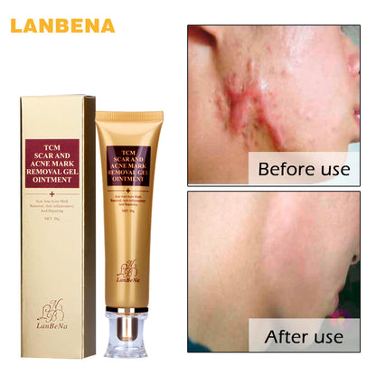 Acne Scar Removal Cream